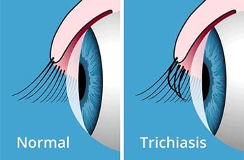 Schéma comparant un œil sain et un œil atteint du trichiasis.